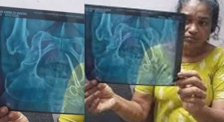 സ്ത്രീയുടെ വയറ്റിൽ കത്രിക കുടുങ്ങിയ സംഭവം കുറ്റക്കാരായ ഡോക്ടർമാർക്കെതിരെ കർശന നടപടി വേണമെന്ന് ആർ. നാസർ.