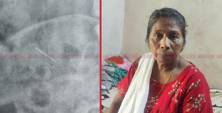 കുത്തിവയ്പെടുത്ത സൂചി ശരീരത്തിൽ ഒടിഞ്ഞിരുന്നു 62 കാരി വത്സല സഹിച്ചത് രണ്ടര വർഷത്തെ കഠിനവേദന